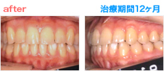矯正治療 After