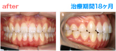 矯正治療 After