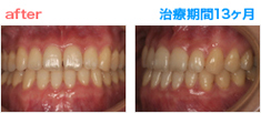 矯正治療 After