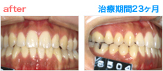 矯正治療 After