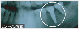 インプラント挿入後